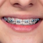 braces for children