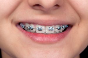 braces for children