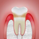 inflamed gums