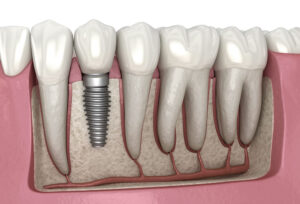 Image showing dental implants.